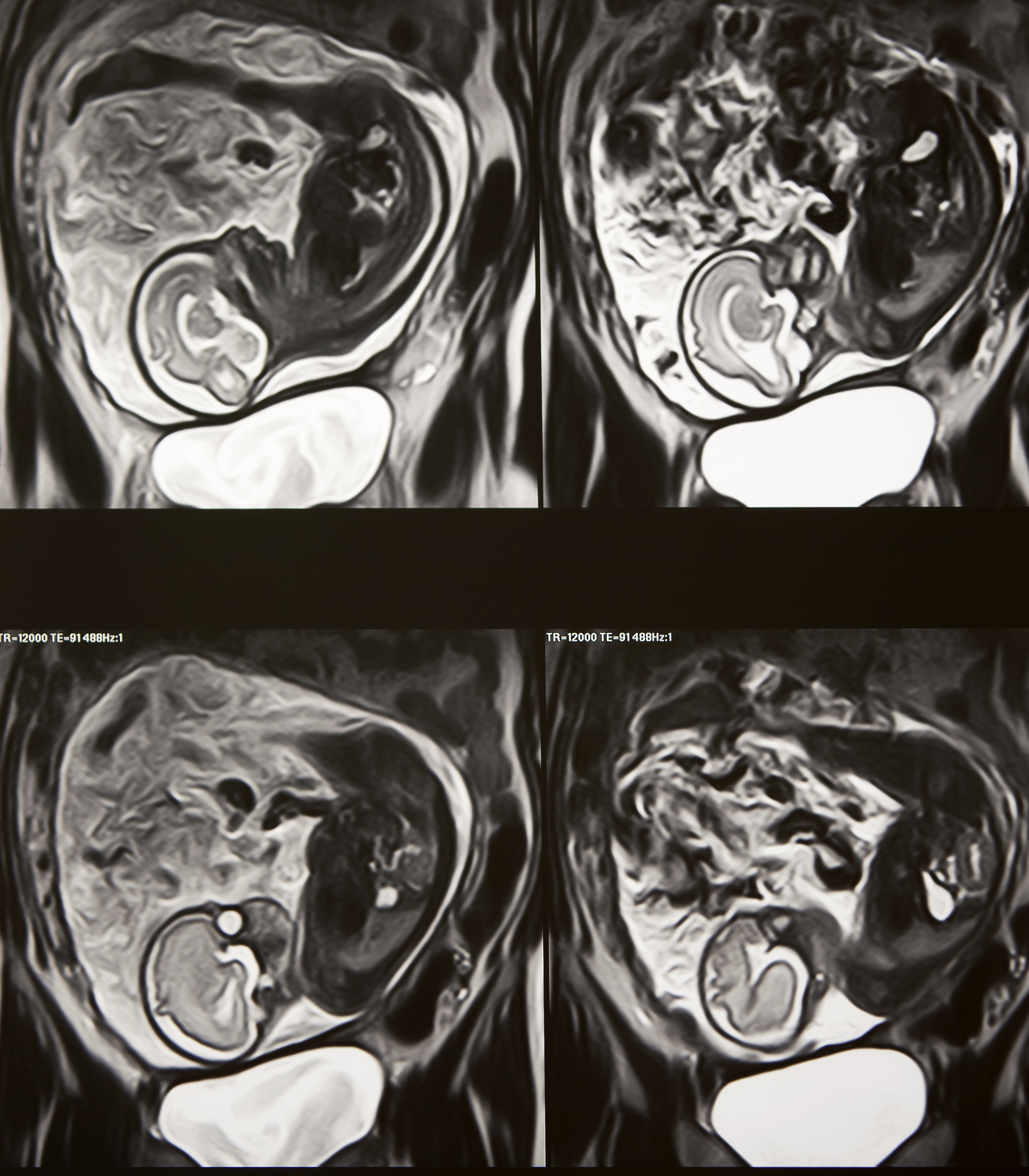 MRI עוברי